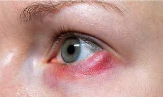 Arpacık Nedir? Gözde Arpacık Neden Olur, Ne Zaman Geçer, Nasıl Geçer?