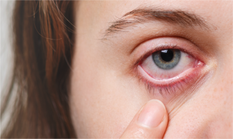 Göz Kuruluğu Nedir?